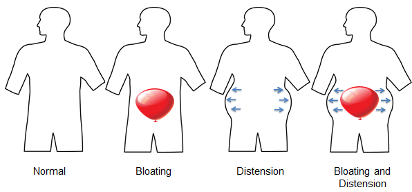 Diagram showing normal digestion, bloating, distension, and combined bloating and distension during gut adjustment